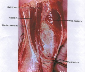 Natural color photograph of left knee, anteromedial view, showing muscles and Pes anserinus