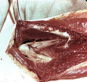 Natural color photograph of dissection of the right shoulder, anterior view, showing the attachment of the tendon of the pectoralis minor muscle to the coracoid process