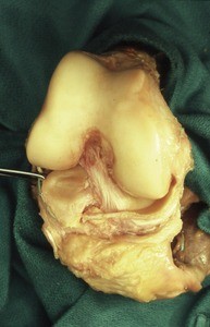 Natural color photograph of dissection of the right knee, anterior view, showing the anterior cruciate ligament