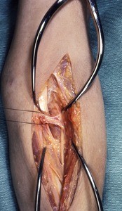 Natural color photograph of dissection of the cubital fossa, anterior view