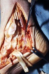 Natural color photograph of dissection of the right ankle, medial view, with a probe at the posterior tibial a