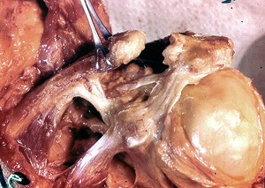 Natural color photograph of dissection of the left shoulder, anterior view, with the acromioclavicular ligament severed and the clavicle retracted from the acromion