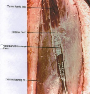 Natural color photograph of left thigh, lateral view, showing muscle and ligament (iliotibial band transverse fibers)