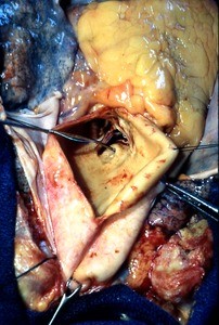 Natural color photograph of dissection of the thorax, anterior view, with the ascending aorta opened to expose the aortic valve and opening of coronary arteries