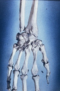 Illustration of bones of right wrist (radius & ulna), & hand (carpals, metacarpals & phalanges), dorsal aspect