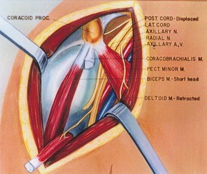 Illustration of dissection of right shoulder, the deltoid retracted, the coracobrachialis reflected, anterior view