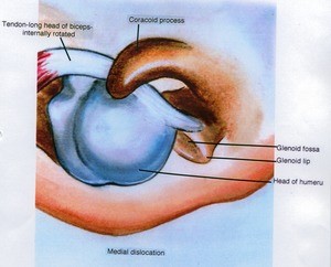 Illustration of the right glenohumeral joint, superior view, showing the relationships between the head of the humerus, long head of the biceps, acromion process, and glenoid fossa in a medial dislocation