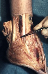 Natural color photograph of dissection of the right ankle, lateral view, emphasing the achilles tendon