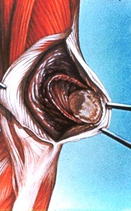 Illustration of surgical exposure of right elbow, showing osteotomy and eversion of olecranon process