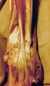 Natural color photograph of dissection of the left forearm, wrist, and hand, posterior view, with the skin and extensor retinaculum removed to expose the forearm extensor muscles and their tendons