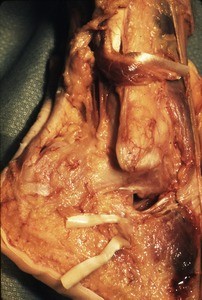 Natural color photograph of dissection of the right ankle, lateral view, with the fibularis longus t. and fibularis brevis t. cut