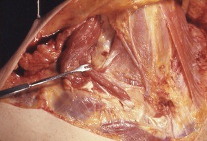 Natural color photograph of dissection of the neck, anterior view, with the right sternocleidomastoid muscle cut and reflected to expose the underlying nerve and tissue structures