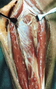 Natural color photograph of dissection of the right arm, posterior view, exposing the deep branch of the radial nerve