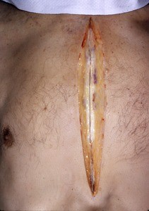 Natural color photograph of the thorax, anterior view, showing an incision directly over the sternum in preparation to retract the skin and expose the mediastinum and lung