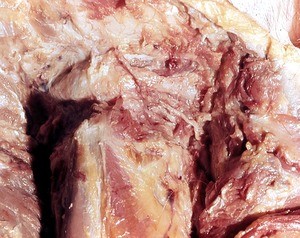 Natural color photograph of dissection of the neck, posterior view, deep dissection with skin and muscle layers reflected