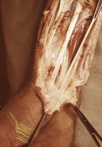 Natural color photograph of dissection of the right wrist, anterior view