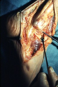 Natural color photograph of dissection of the right ankle, lateral view