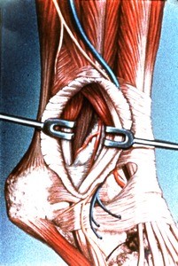 Illustration of sugical exposure of deep structures overlying right lateral malleolus, lateral view