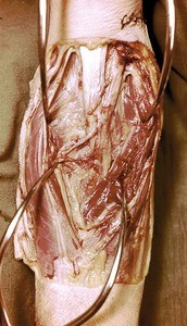 Natural color photograph of dissection of the forearm