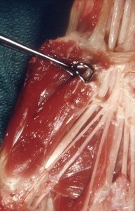 Natural color photograph of dissection of the right hand, anterior view, emphasizing the the flexor pollicis brevis muscle