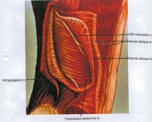 Illustration of dissection of the right abdominal muscles, 12th intercostal nerve and iliohypogastric nerve, lateral view