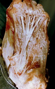 Natural color photograph of dissection of the plantar surface of the left foot