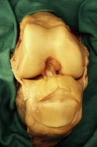 Natural color photograph of dissection of the right knee, anterior view, with the patella reflected inferiorly