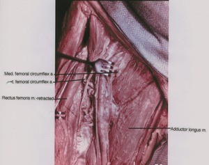 Natural color photograph of right upper thigh, anterior view, showing muscles and femoral circumflex arteries with femoral vessels and rectus femoris muscle retracted