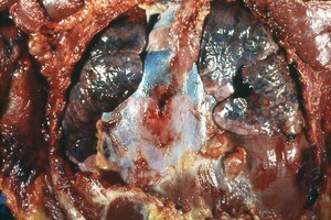 Natural color photograph of dissection of the thorax, anterior view, with the ribcage removed to reveal a penetrating wound in the mediastinum