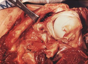 Natural color photograph of dissection of the left shoulder, anterior view, with the clavicle retracted from the coracoid process and the glenohumeral joint capsule opened to expose the head of the humerus