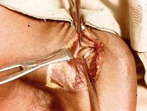 Natural color photograph of dissection of the left shoulder, anterior view, exposing the joint capsule and humeral head