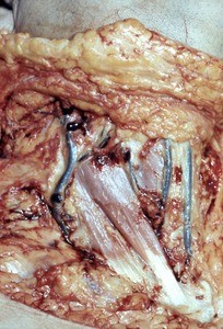 Natural color photograph of dissection of the right side of the neck, anterior view, showing the sternal and clavicular head of the right sternocleidomastoid muscle, the external jugular vein, and the right and left anterior jugular veins