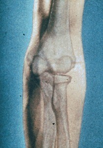 Illustration of left elbow and forearm, anterior view, with humerus, radius and ulna lying on its articular surface, all ghosted in