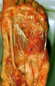 Natural color photograph of dissection of the plantar surface of the left foot