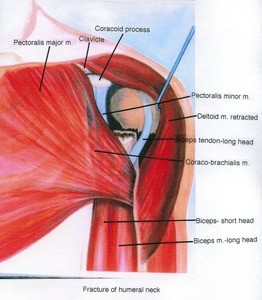 Illustration of the left shoulder, anterior view, showing bones, muscles, and tendons with the deltoid muscle retracted to expose the humerus fractured at the surgical neck