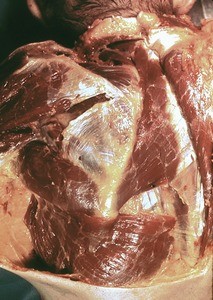 Natural color photograph of dissection of the left shoulder, posterior view, with the trapezius muscle reflected to expose the muscles of the posterior shoulder