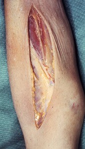 Natural color photograph of dissection of the cubital fossa, anterior view