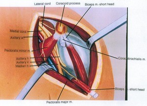 Illustration of dissection of left shoulder, the deltoid retracted, the coracobrachialis reflected, anterior view