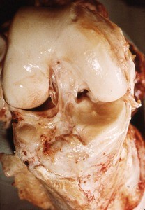 Natural color photograph of dissection of the right knee joint, anterior view, showing the femural and tibial surfaces, as well as the anterior cruciate ligament