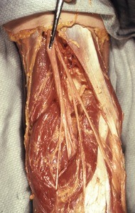 Natural color photograph of dissection of the popliteal fossa, emphasizing the sciatic nerve and its branches