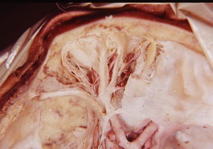 Natural color photograph of dissection of the orbit, superior view, showing the muscles of the eye, the optic nerve, branches of the ophthalmic nerve, as well as other nerves