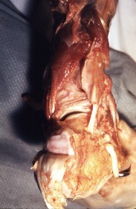 Natural color photograph of dissection of the right foot, posterior view, showing the subtalar joint, with the calcaneal tendon cut and reflected