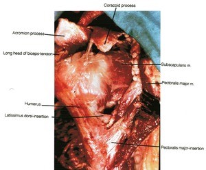 Natural color photograph of dissection of the right shoulder, superior view, showing bone and muscle structure