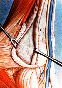 Illustration of exposure of muscles and bones of right ankle (fibulo-calcaneal) joint, lateral view