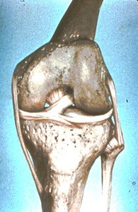 Illustration of articulated bones of left knee, anterior view (femur, tibia, fibula) and ligaments of knee joint: anterior cruciate & posterior cruciate ligs.,medial lemniscus, lateral lemniscus, tibial collateral ligament, fibular collateral ligament; medial and lateral fibular condyles