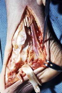 Natural color photograph of dissection of the right ankle, medial view, with a probe behind the tibial nerve