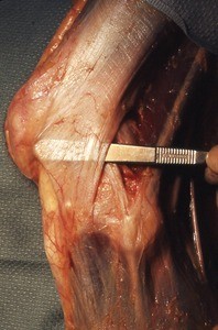 Natural color photograph of dissection of the left knee, lateral view, with the scalpel under the iliotibial tract