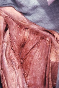 Natural color photograph of dissection of the right femoral triangle, with the femoral vessels cut and removed