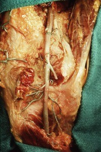 Natural color photograph of dissection of the left popliteal fossa, showing the popliteal artery