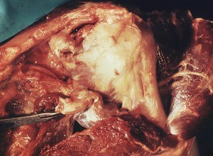 Natural color photograph of dissection of the left shoulder, anterior view, with the deltoid muscle retracted to reveal the axillary nerve and the surgical neck of the humerus